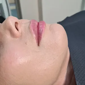 MODELOWANIE UST - Modelowanie ust 1ml - zdjęcie 7