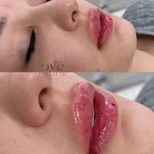 MODELOWANIE UST - Modelowanie ust 1ml - zdjęcie 10